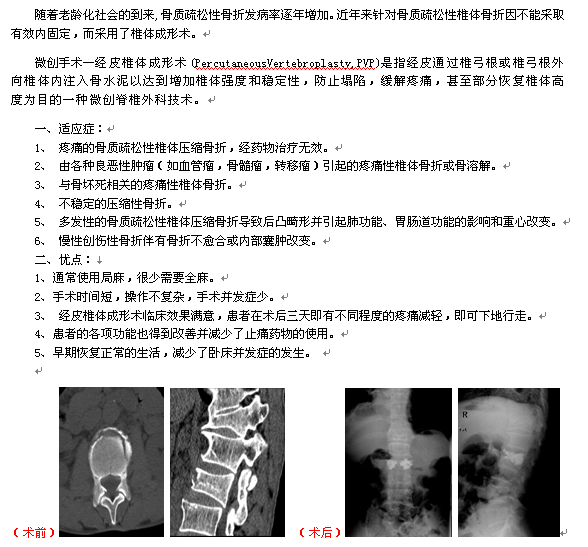 骨科——经皮椎体成形术治疗骨质疏松性椎体骨折