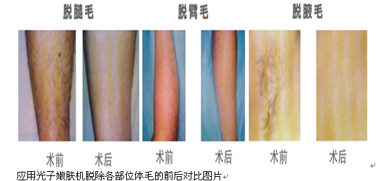 皮肤科最新仪器设备——光子嫩肤机