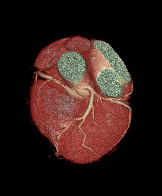 【CT科】宝石能谱CT心脏冠脉高清低剂量体检
