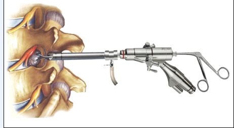 【骨伤科】椎间孔镜脊柱微创手术的适应人群