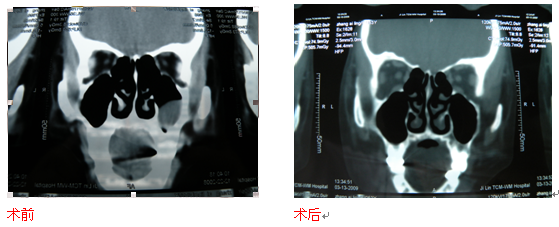 【耳鼻喉科】中西合璧的微创鼻内镜外科