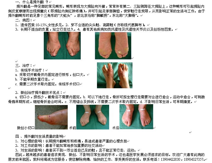 【骨科】微创截骨治疗拇趾外翻畸形（大脚骨）