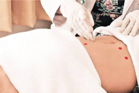 我院开展“长效针灸—穴位埋线”减肥