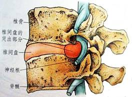 【骨伤科】腰椎间盘突出症