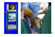 骨科引进新设备——关节镜微创技术（Styker公司第四代产品）