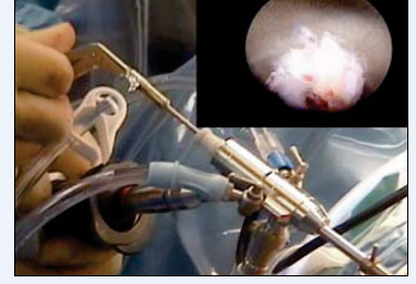 骨伤科开展椎间孔镜下腰椎间盘摘除术